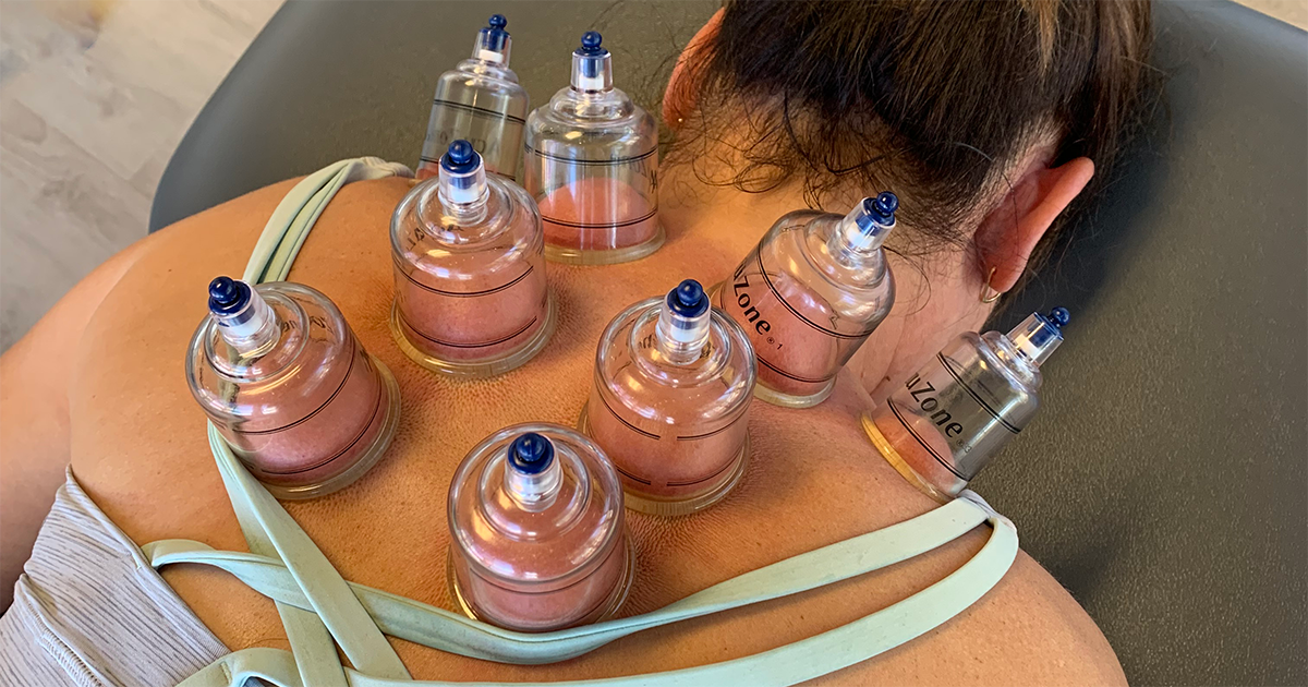 Cupping Therapy