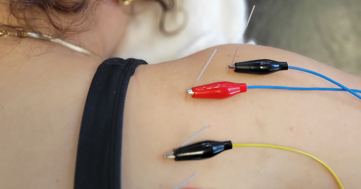 Dry Needling